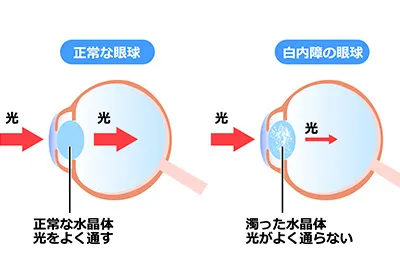 白内障のイラスト