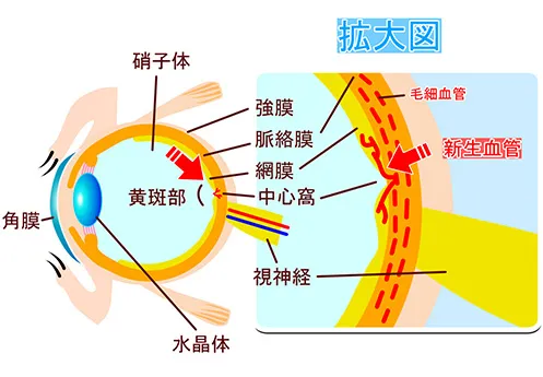 黄斑変性のイラスト